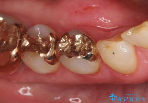 金属の詰め物が外れた。の治療後