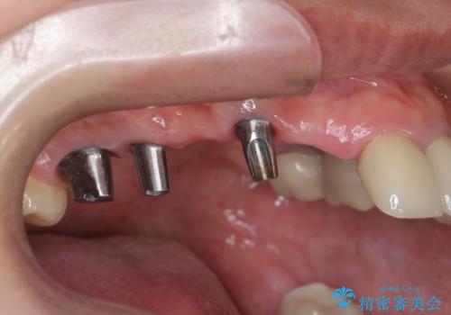虫歯による多数歯欠損 インプラント咬合機能回復の治療中