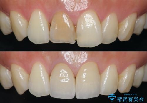 前歯の変色　根管治療と高品質セラミック歯科治療