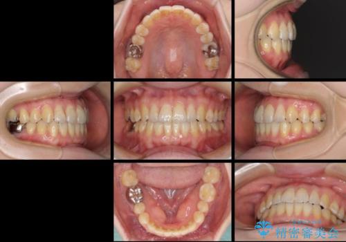 前歯のデコボコを治したい インビザラインによる矯正治療の治療後