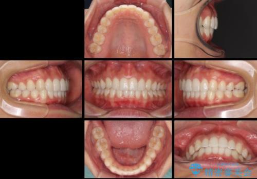 ディープバイトと前歯のデコボコを治したい インビザラインによる矯正治療の治療後