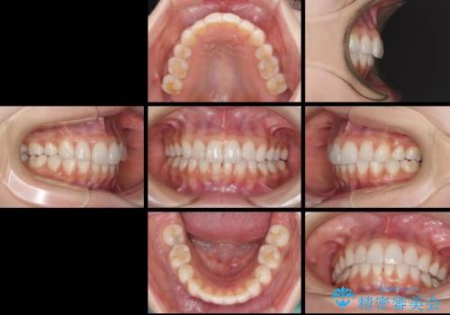 矯正治療の後戻り インビザラインによる再矯正治療の治療後