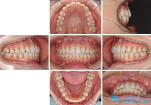 話しにくいオープンバイト インビザラインによる矯正治療の治療後