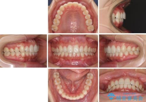 海外勤務中でも矯正治療 インビザラインによる軽度叢生改善の治療後