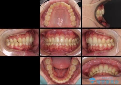 深い咬み合わせと前歯のデコボコの改善 インビザラインによる矯正治療の治療後