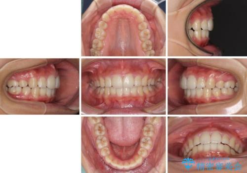 口が閉じられない 抜歯矯正で口元をスッキリとの治療後