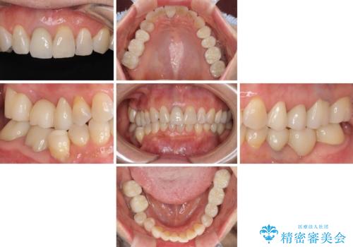金属を全てセラミックに メタルフリー治療の治療後