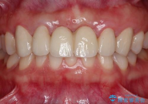 前歯 ブリッジ周囲の腫れた歯ぐきを改善の治療後