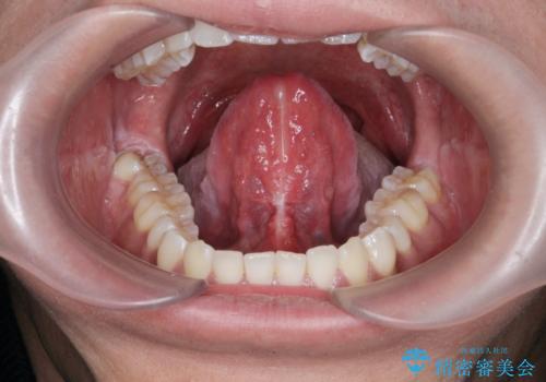 [滑舌が気になる] 舌小帯形成術の治療後