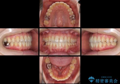 前歯のデコボコを治したい インビザラインによる矯正治療の治療中