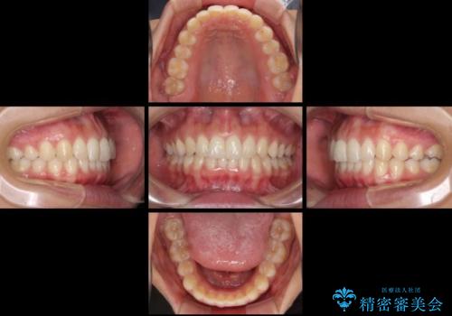 ディープバイトと前歯のデコボコを治したい インビザラインによる矯正治療の治療中