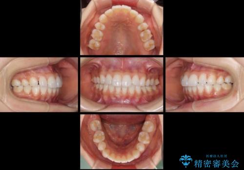 矯正治療の後戻り インビザラインによる再矯正治療の治療中