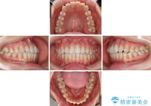 話しにくいオープンバイト インビザラインによる矯正治療の治療中