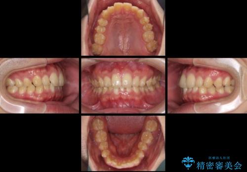 深い咬み合わせと前歯のデコボコの改善　インビザラインによる矯正治療の治療中