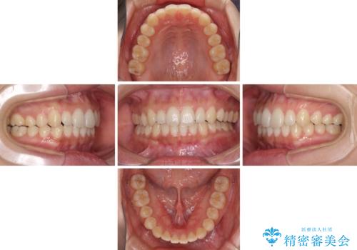 海外勤務中でも矯正治療 インビザラインによる軽度叢生改善の治療中