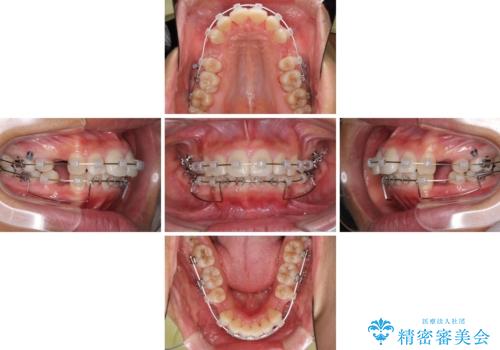 口が閉じられない 抜歯矯正で口元をスッキリとの治療中