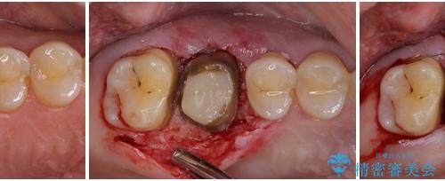 歯周外科処置を併用した奥歯の補綴治療の治療中