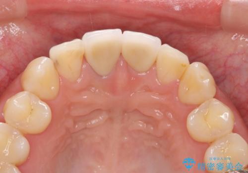前歯の変色　根管治療と高品質セラミック歯科治療の治療後