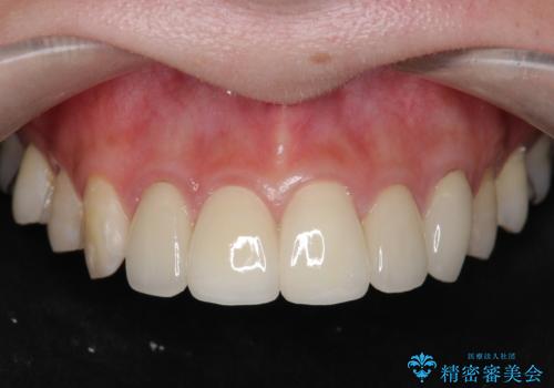 不適合なクラウンのやりかえの治療後