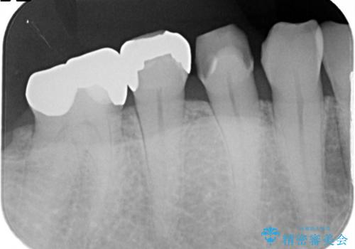 金属の詰め物が外れた。の治療前