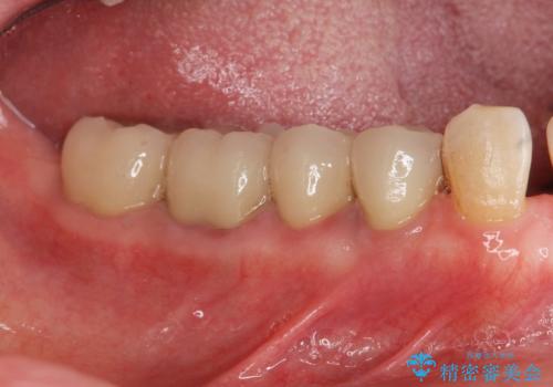 大臼歯　再根管治療の治療後