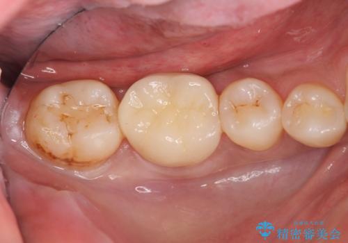 目立つ銀歯を白くしたいの治療後