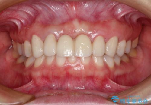 前歯 ブリッジ周囲の腫れた歯ぐきを改善の治療後