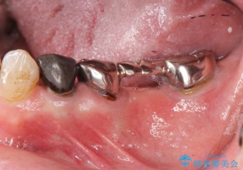 [奥歯のセラミック治療] 銀歯のブリッジを白くの症例 治療前