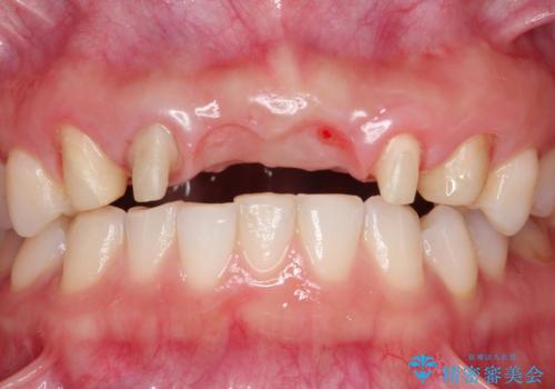 前歯 ブリッジ周囲の腫れた歯ぐきを改善の治療中
