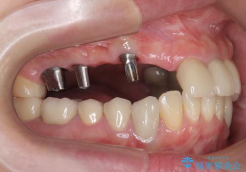 虫歯による多数歯欠損 インプラント咬合機能回復の治療中