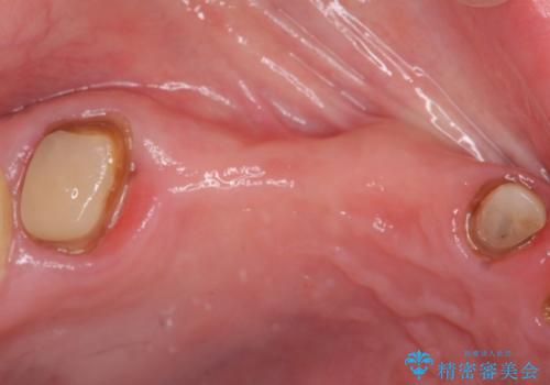 虫歯による多数歯欠損 インプラント咬合機能回復の治療前
