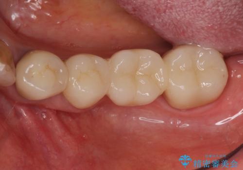 [奥歯のセラミック治療] 銀歯のブリッジを白くの治療後