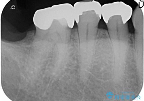 金属の詰め物が外れた。の治療後