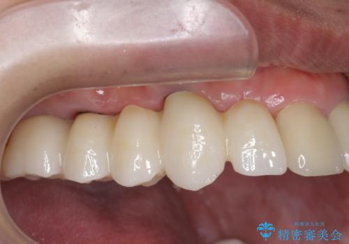 虫歯による多数歯欠損 インプラント咬合機能回復の治療後