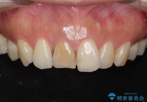 前歯の変色　根管治療と高品質セラミック歯科治療の症例 治療前