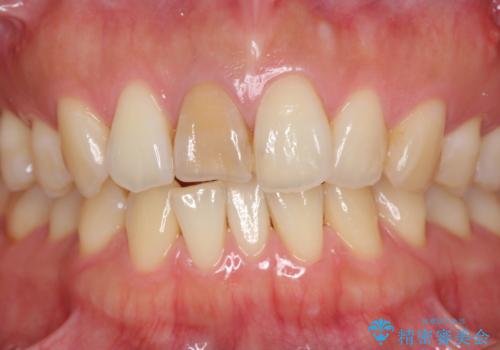 前歯の変色 根管治療と高品質セラミック歯科治療の治療前