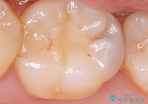 マイクロスコープ下で行う精密虫歯治療の症例 治療前