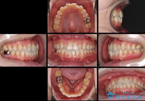 前歯のデコボコを治したい インビザラインによる矯正治療の治療前