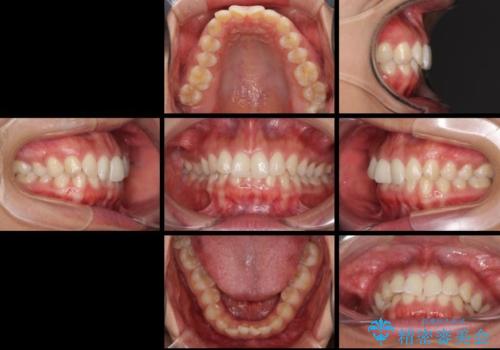 ディープバイトと前歯のデコボコを治したい インビザラインによる矯正治療の治療前