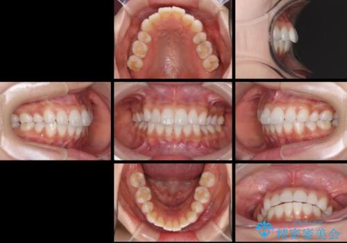矯正治療の後戻り インビザラインによる再矯正治療の治療前