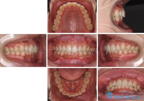 海外勤務中でも矯正治療 インビザラインによる軽度叢生改善の治療前