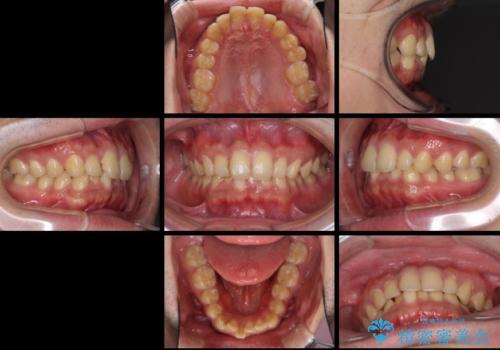 深い咬み合わせと前歯のデコボコの改善 インビザラインによる矯正治療の治療前