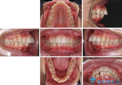 口が閉じられない 抜歯矯正で口元をスッキリとの治療前