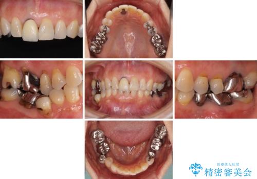 金属を全てセラミックに メタルフリー治療の治療前