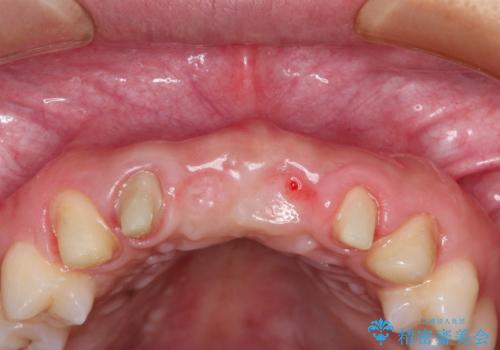 前歯 ブリッジ周囲の腫れた歯ぐきを改善の治療中