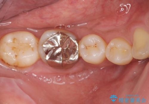 目立つ銀歯を白くしたいの治療前