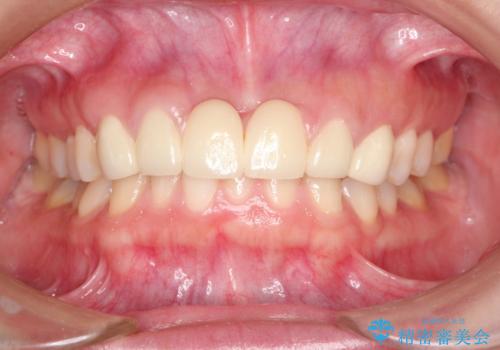 前歯　ブリッジ周囲の腫れた歯ぐきを改善の治療前