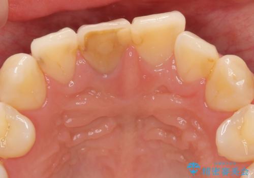 前歯の変色　根管治療と高品質セラミック歯科治療の治療前