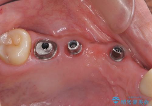 虫歯による多数歯欠損　インプラント咬合機能回復の治療中