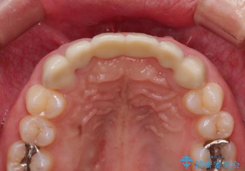 前歯　ブリッジ周囲の腫れた歯ぐきを改善の治療後